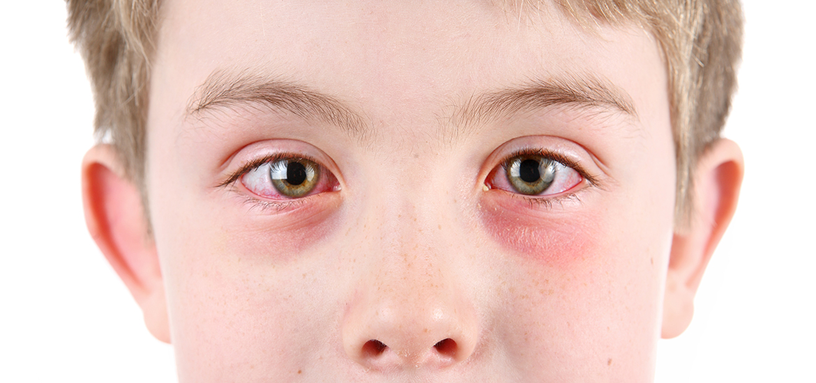 Pink Eye: What You Should Know